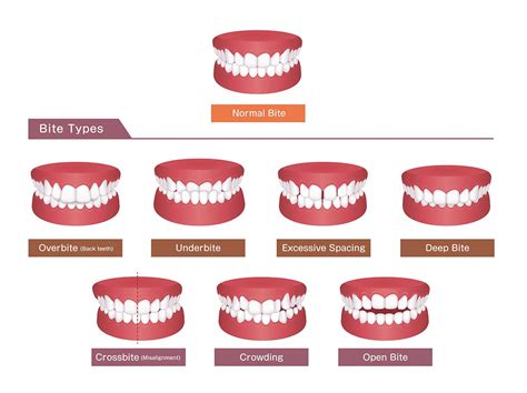 Different Type Of Bites Teeth