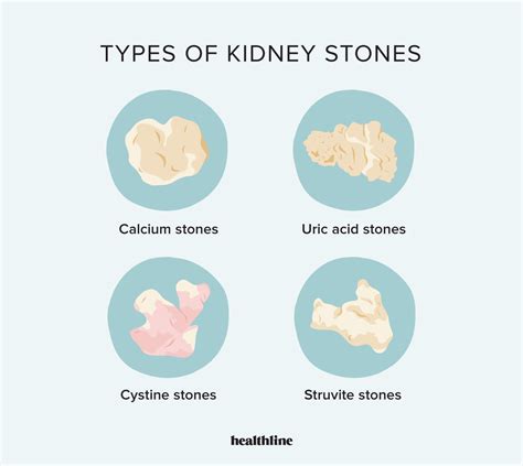 different types and sizes of kidney stones