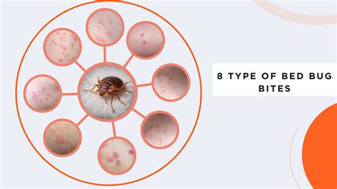 Different Types Of Bed Bug Bites