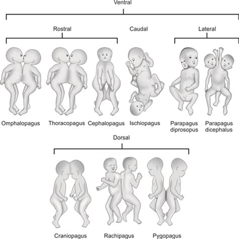 different types of conjoined twins