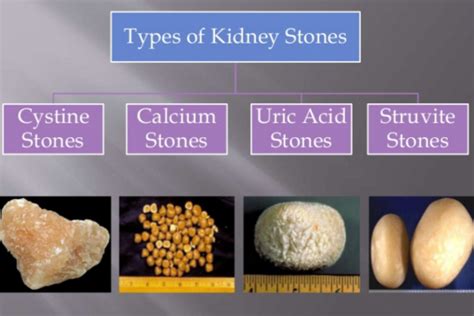 different types of kidney stones