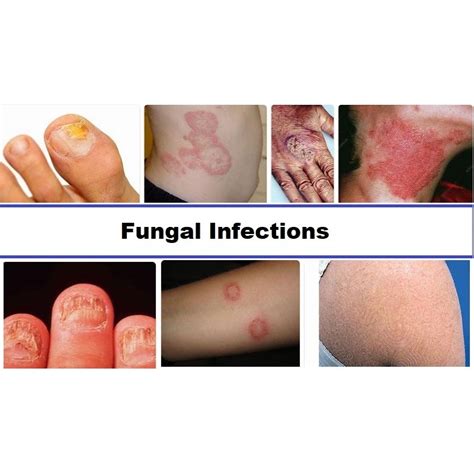 different types of skin fungus pictures