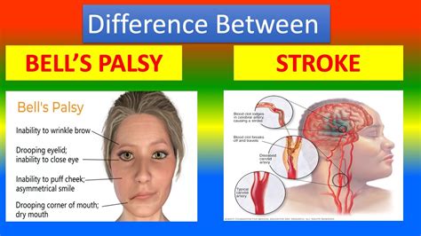 differentiating bell's palsy from stroke