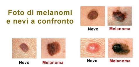differenza tra melanoma e carcinoma