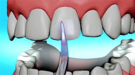 Difficulties In Bonding To Tooth Structure