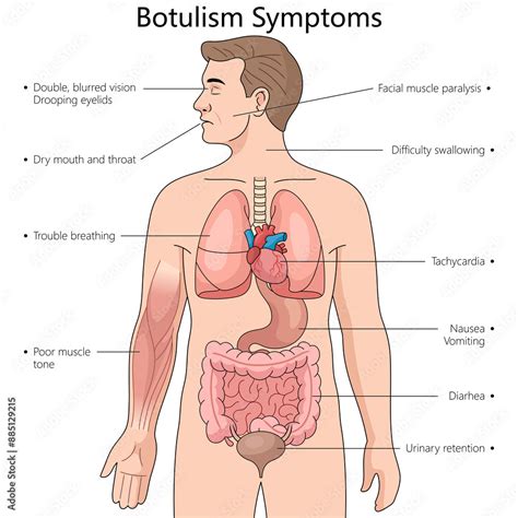difficulty swallowing botulism