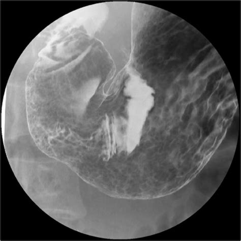diffuse gastric wall thickening radiology