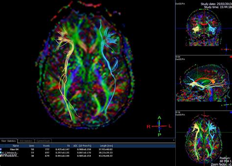 diffusion tensor imaging in the courtroom