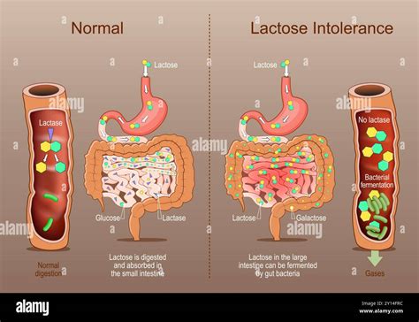 Digestive System Lactose Intolerance