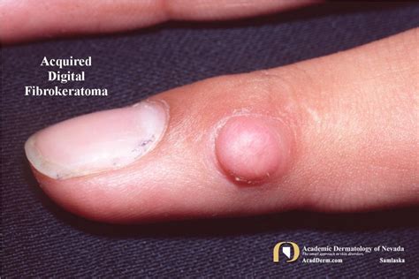 digital fibrokeratoma