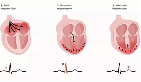 Digitalis Induced Arrhythmia