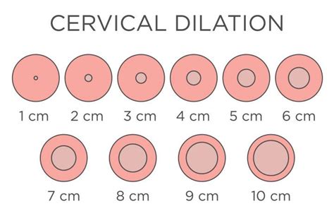 Understanding Dilated 1 Centimeter: Labor and Delivery Insights