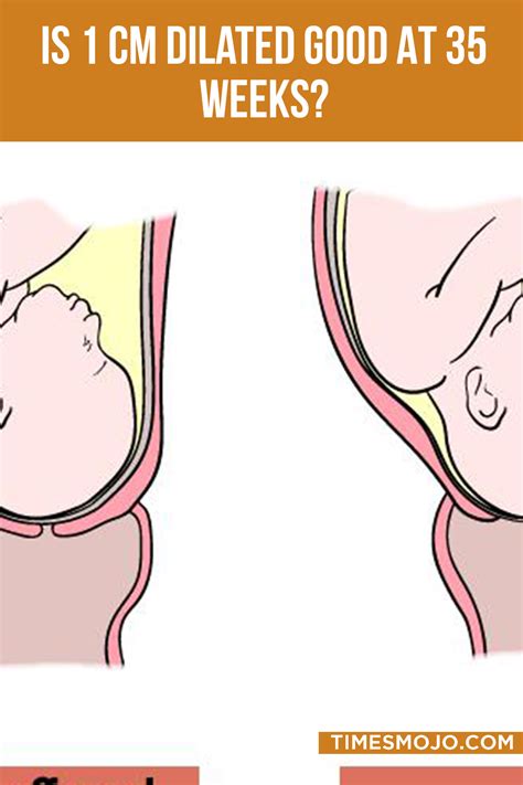 dilated 1cm at 35 weeks