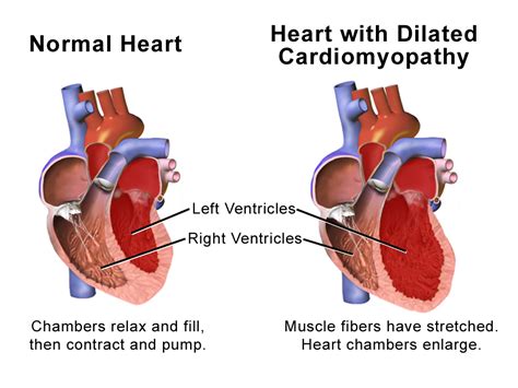 Understanding Dilated Heart Disease: Causes, Symptoms, and Effective Treatment Options