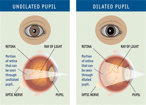 What Happens When a Doctor Dilated the Eyes?