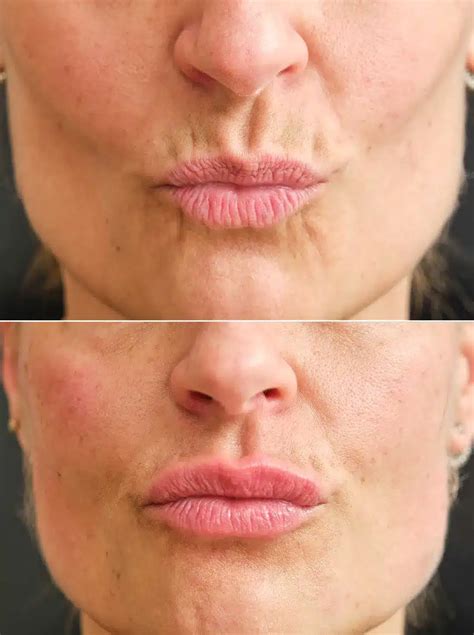 Diminish Lines Around Mouth