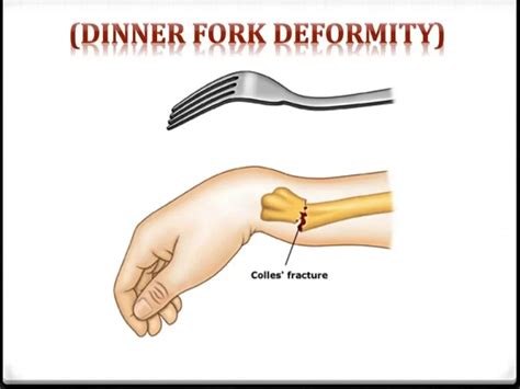 Dinner Fork Abnormality