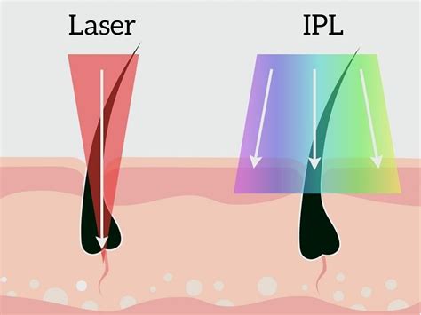 diode laser hair removal reddit