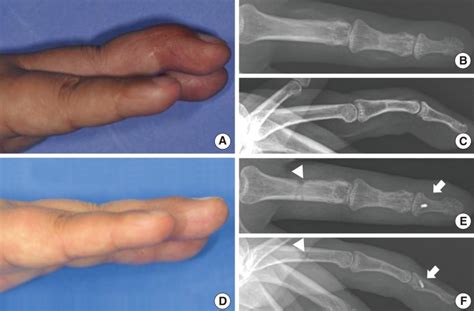 Dip Joint Extensor Lag
