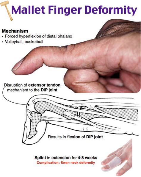 Dip Joint Mallet Finger