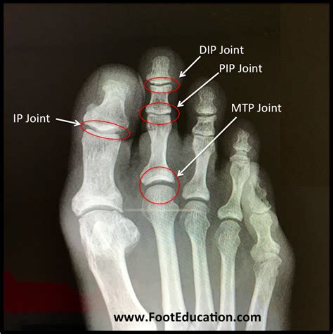 Dip Joint Of Toe