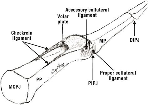 Dip Joint Volar Plate