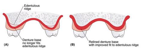 Direct Denture Reline