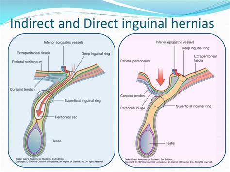 direct indirect inguinal hernia