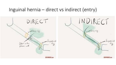 direct inguinal hernia in women