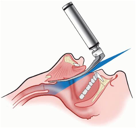 Direct Laryngoscopy Anesthesia