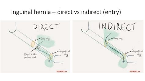 direct left inguinal hernia