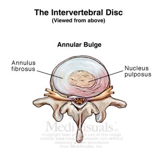 Disc Annular Meaning