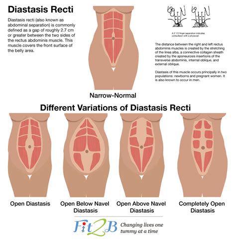 discourse And Management Of Diastasis Recti