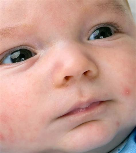 discourse For Petechiae In baby