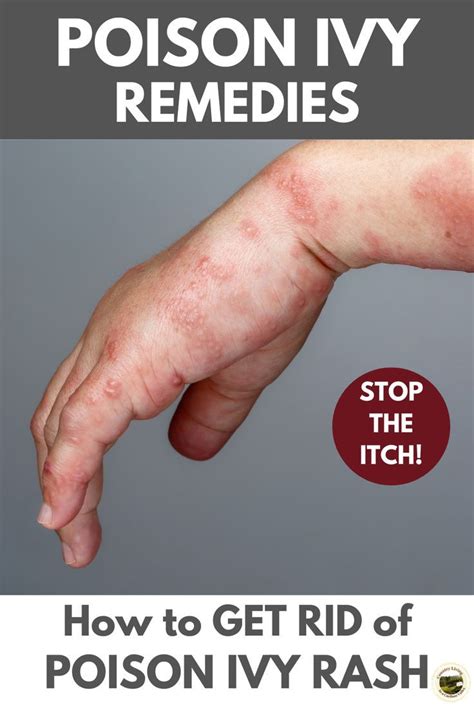 discourse For Poison Ivy Rash