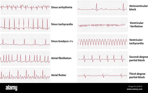 Discuss About Ecg