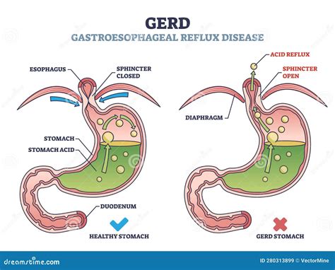 discussion For Acid Reflux And GERD In minor