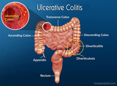 diseases of the ascending colon