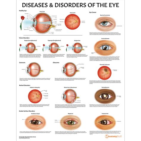 diseases of the eye