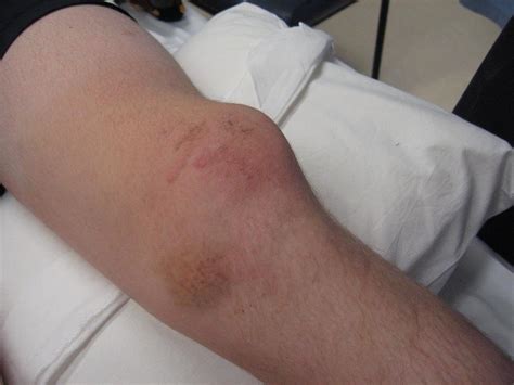 Understanding and Managing a Dislocated Knee Cap Injury Effectively