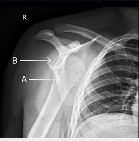Dislocated Shoulder X-Ray: Quick Expert Insights