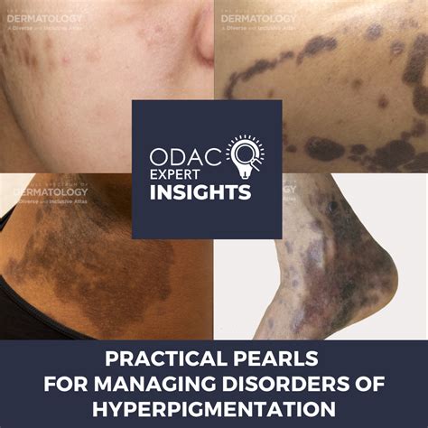 Understanding Hyperpigmentation Disorders: Causes And Treatments