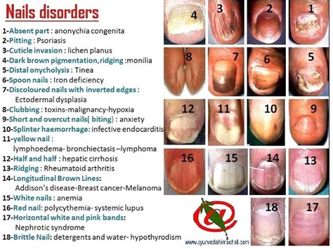 Understanding Common Disorders Of Nails And What They Mean