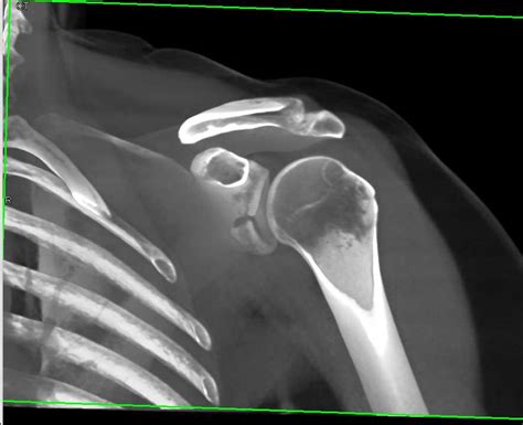 displaced fracture of glenoid