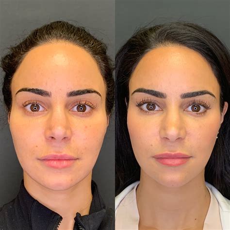 Dissolving Cheek Filler Before and After Results Doctor Lanna