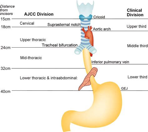 distal esophageal carcinoma icd 10