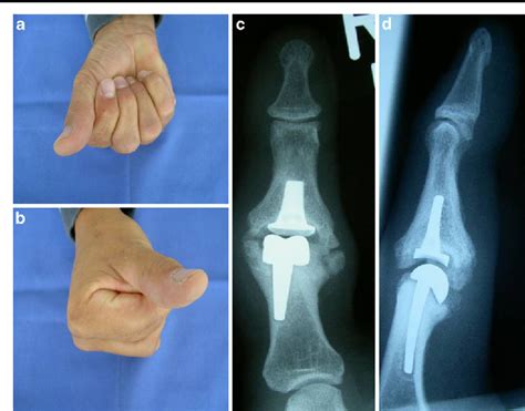 Distal Interphalangeal Joint Replacement
