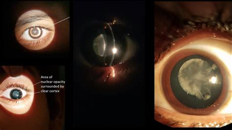 Distant Direct Ophthalmoscopy Cataract