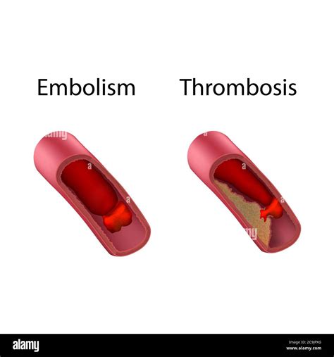 distinguish between a thrombus and an embolus