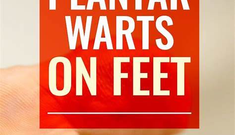 15 Home Remedies for Warts Easy Home Wart Treatments